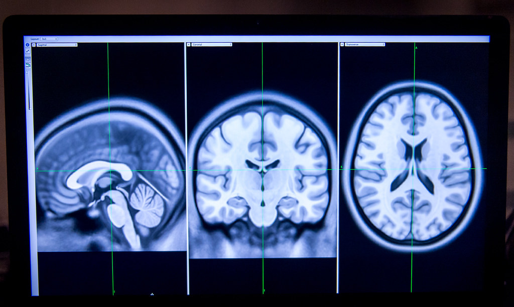 Imagens de ressonância magnética, usadas para análise de regiões do cérebro.