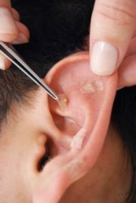 acupuntura orelha